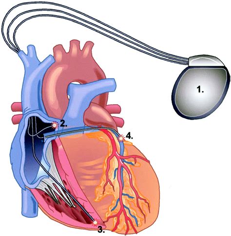 coronary sinus pacer lead.